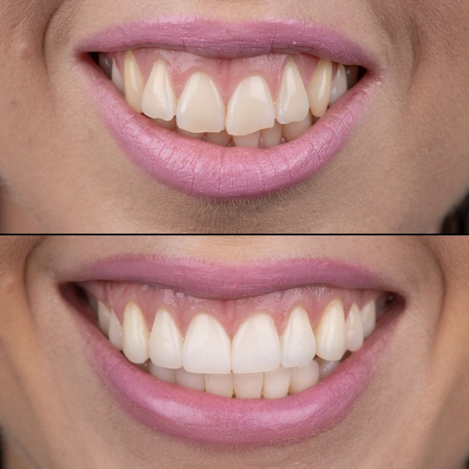Zmanjšanje gummy smile z nevidnim zbnim aparatom