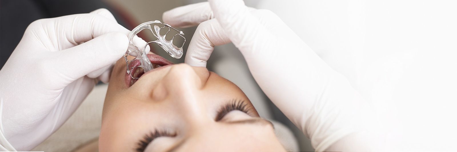 Slider inman aligner ali hitra ortodontija fliped 74ab3d7d