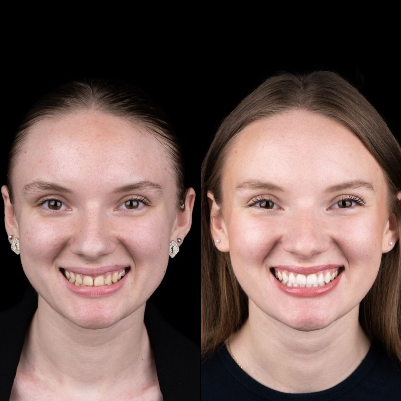Zapiranje diastem in zmanjšanje gummy smile z nevidnim zbnim aparatom.