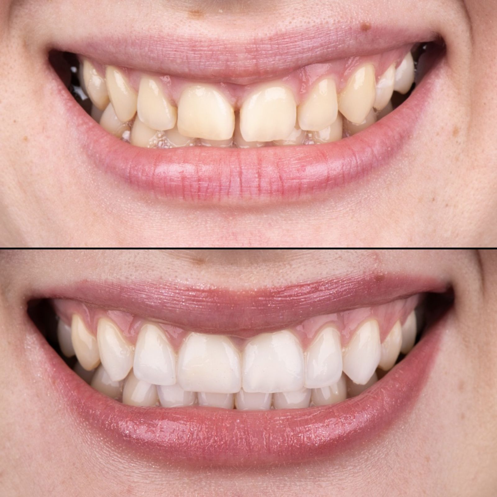 Zapiranje diastem in zmanjšanje gummy smile z nevidnim zbnim aparatom.
